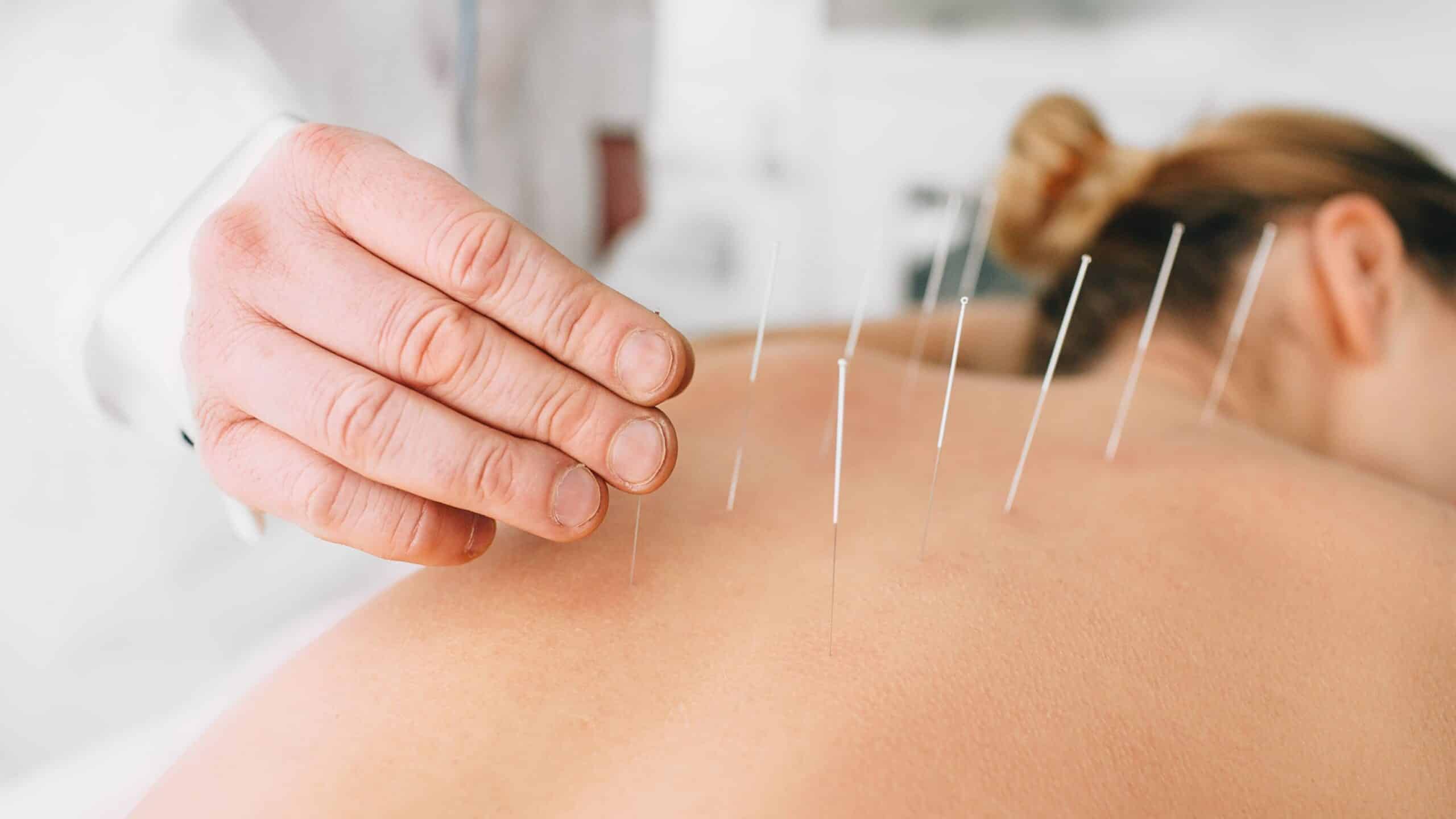 Acupuncture